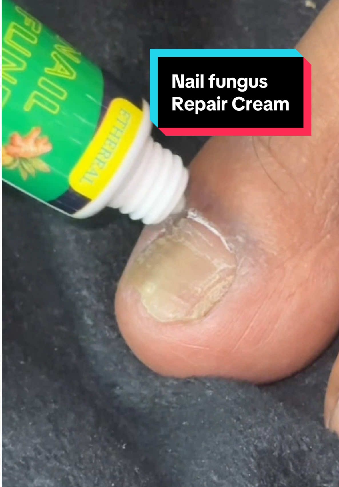 Nail fungus Repair Cream.                        ##nail##fungusnails##trending##goviral##creatersearchingsight