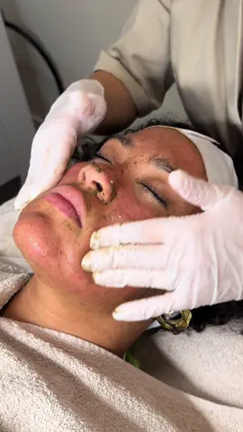 One of my favorite peelings: de Biopeeling ✨ Last van een doffe, schrale huid, pigment, acne of onzuiverheden? Dan is de Biopeeling dé behandeling voor jou! Binnen 7 dagen een gloednieuw babyhuidje. 📲 www.oumaimaskintherapy.com 📞+31 6 51 87 29 05 #acne #acnebehandeling #pigmentatie #skinbooster #facial 
