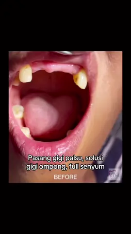 Proses pemasangan gigi, akrylik denture, minat langsung dm #tukanggigi #gigipalsumurah #denpasarbali #lumajang #fypberanda 
