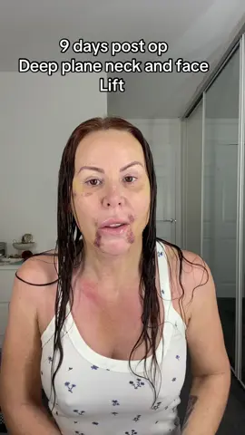 #deepplanenecklift #facelift #cosmeticsugery #istanbul #fyp 