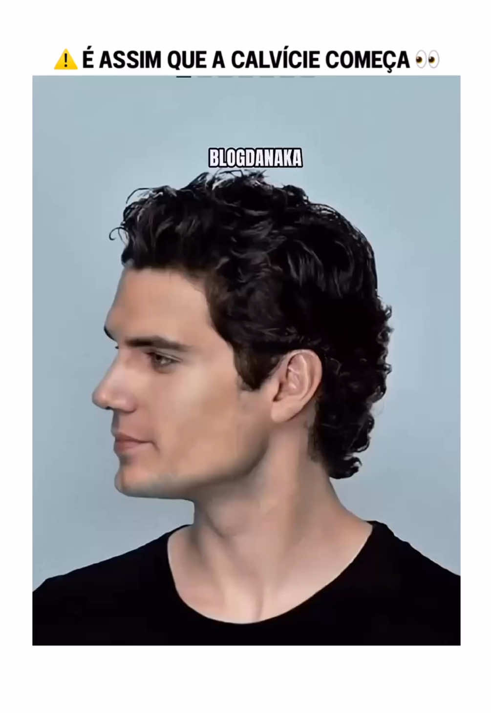 A calvície segue um padrão — e ninguém fala sobre isso‼️ Quando você entende esse padrão, tudo faz sentido.👀 #calvicie #quedadecabelo #cuidadoscomcabelo 
