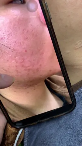 Cập nhập da khách #chamsocdamun#chamsocdaseo#chamsocdanam#tanbinh#Lqspa&academy