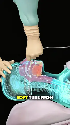 Nasogastric Tube Insertion (NG Tube)– How It’s Done #ngtube #ngtubeawareness #ngtubeawareness 