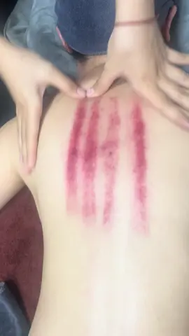 💤 𝐌𝐚̂́𝐭 𝐧𝐠𝐮̉ - 𝐃𝐚̂́𝐮 𝐡𝐢𝐞̣̂𝐮 “𝐛𝐚́𝐨 đ𝐨̣̂𝐧𝐠” 𝐜𝐮̉𝐚 𝐜𝐨̛ 𝐭𝐡𝐞̂̉  Nhiều người thường xem việc khó ngủ, trằn trọc là chuyện nhỏ. Nhưng thật ra, mất ngủ chính là lời “kêu cứu” âm thầm mà cơ thể đang gửi đến bạn. 💢 Khi khí huyết không lưu thông, cơ bắp căng cứng, thần kinh căng thẳng, não bộ khó được thư giãn, giấc ngủ trở nên chập chờn, mệt mỏi kéo dài. 🌿 Massage trị liệu tại Hạnh Hí giúp:  ✨ Khơi thông kinh lạc, điều hòa khí huyết, giảm nhức mỏi toàn thân ✨ Làm dịu nhẹ thần kinh, giúp ngủ sâu và ngon giấc ✨ Cân bằng tinh thần, giải tỏa stress, lấy lại năng lượng tích cực Một buổi massage đúng cách không chỉ là thư giãn, mà là chữa lành từ cơ thể đến tâm trí. 📞 Đặt lịch ngay hôm nay để được ưu tiên trải nghiệm #massagebody #GoiDauDuongSinh ##SpaHanhHi #trịlieucovaigay #DuongSinhHanhHi 