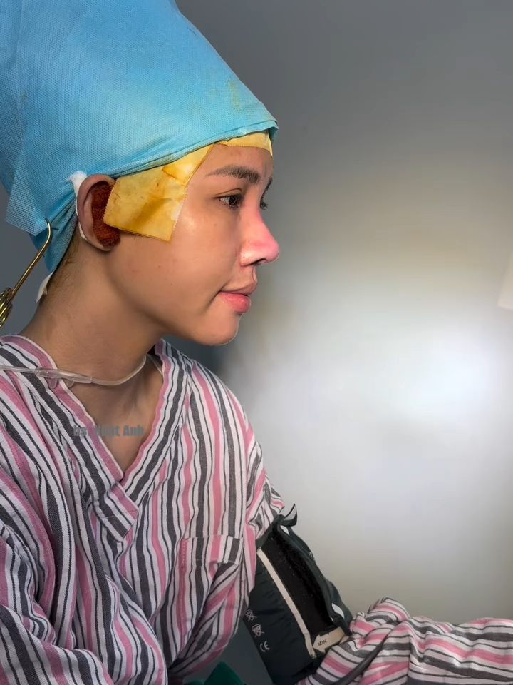 Dáng mũi này ổn định sẽ cho ra một siêu phẩm 😍  #nangmuicautruc #nangmuisurgiform #suamuihong #PHẪUTHUẬTTHẨMMỸ