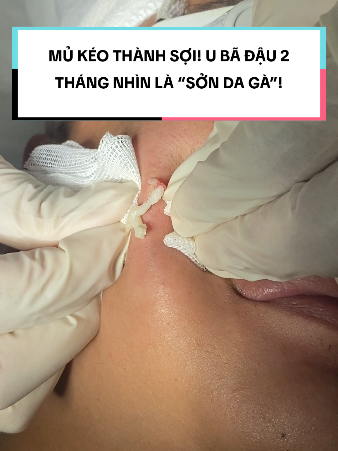 Khách để khối u bã đậu quá lâu khiến mủ đặc lại, kéo thành sợi dài khi xử lý #hhvclinic #xuhuong #thamkhamdamienphi #nanmunchuanykhoa #acne #ubadau #fyp #munnhot #trending
