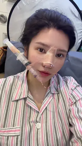 美女医美整形之在上海变美的重生之前后对比鼻型 #nosejob #rhinoplasty #beforeandafternose #3dnosedesign #beautytransformation 