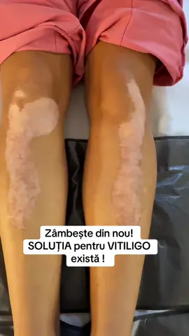 Dragi clienți cu Vitiligo!  Acesta postare este pentru voi. Atunci când ai încercat tot și de toate ,și nu a funcționat ,afli ca soluția pentru Vitiligo există . Camuflarea Skin Story ,permanentă îți va aduce zâmbetul pe buze. E momentul să îți iei decizia dacă ai vitiligo . #vitiligo #camuflarelondra #vitiligobucuresti 
