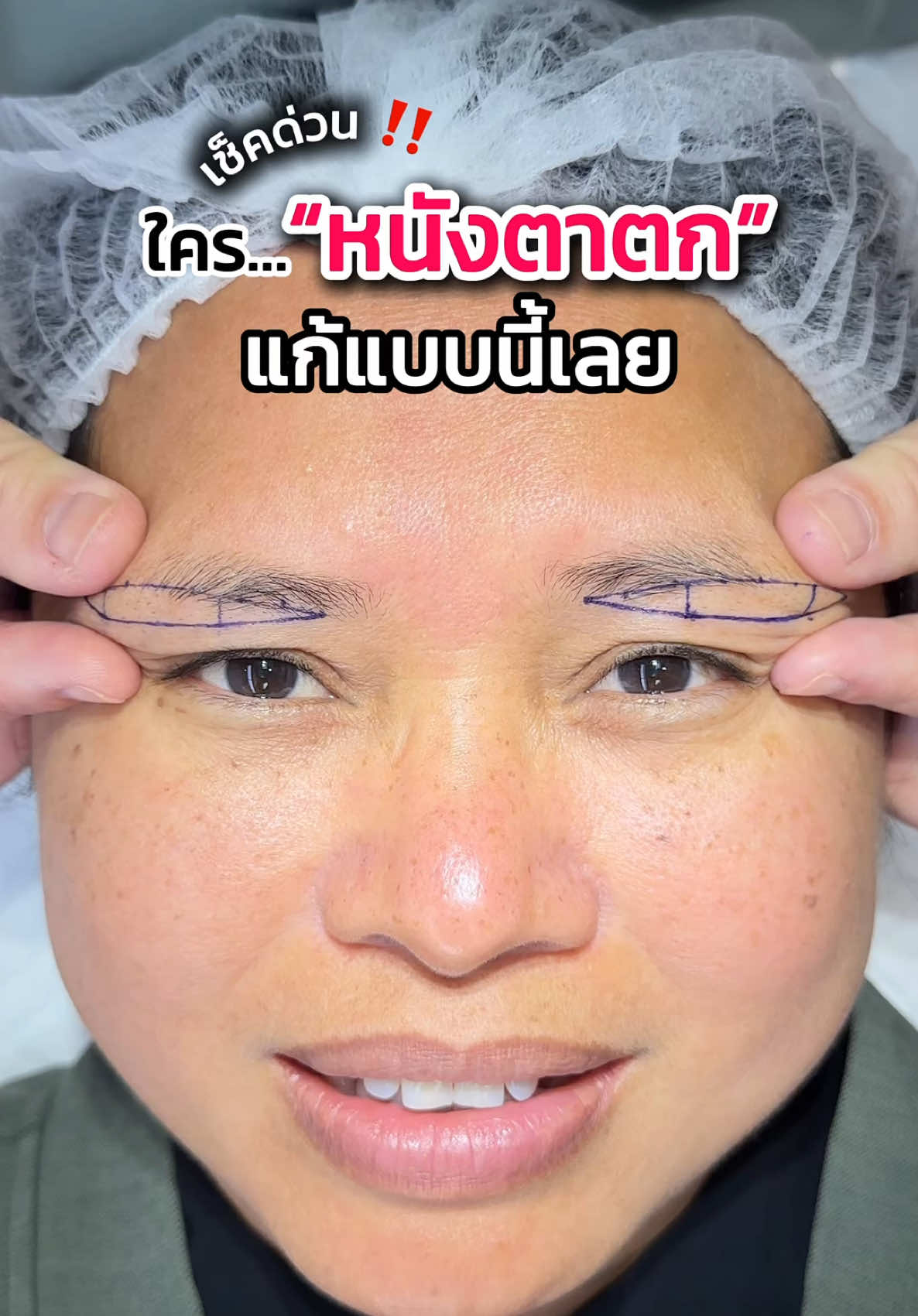 เช็คด่วน‼️ ใครหนังตาตกแก้แบบนี้เลย #หมอเฟิร์นfernclinic #subbrowlift #ตาสวย #ศัลยกรรม #เทรนด์วันนี้