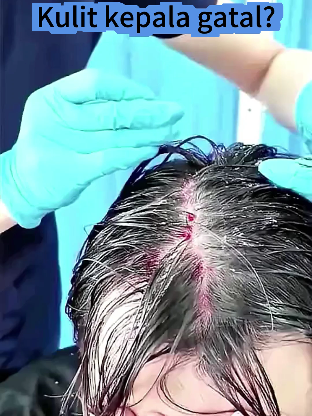 Kepala gatal & berkelemumur? Cuba DermioLab sekarang!1121-wck-xfs-08w2#jerawatkulitkepala #minyakrambut #antikelemumur #dandruffscratching