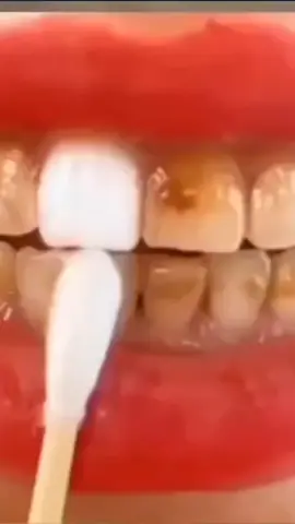 Blanquea los dientes amarillos y lleno de sarros