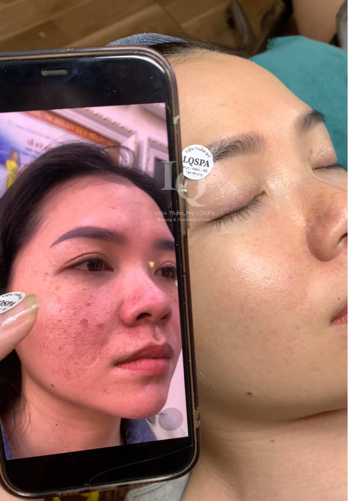 Cập nhật da mụn #chamsocdamun#chamsocdaseo#chamsocdanam#tanbinh#Lqspa&academy