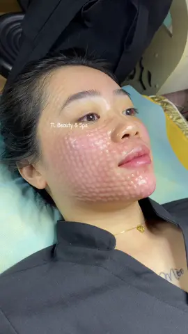 Quá đẹp- xuất sắc 😎#tiêm_meso #Meso_căng_bóng_trắng_sáng #meso_phục_hồi #meso_trắng_da #xh 