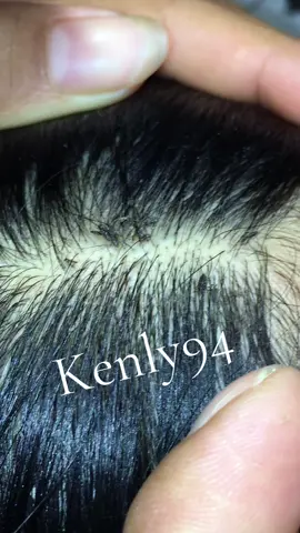 Remove lice #lice😰😰😰 #😱😱😱 #😭😭😭 #😍😍😍 #liceremoval 