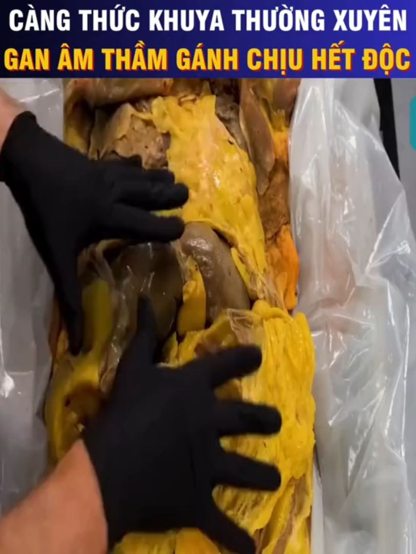 Càng thức khuya thường xuyên. Lá gan âm thầm gánh chịu hết độc tố #GiảiMãSứcKhỏe #GiảiMãCơThể #HiểuCơThểMình #SứcKhỏeMỗiNgày #HealthyVietnam #TheHealthLab #KhoaHọcVui #BodyInside #HealthEducation #SốngKhỏeMỗiNgày