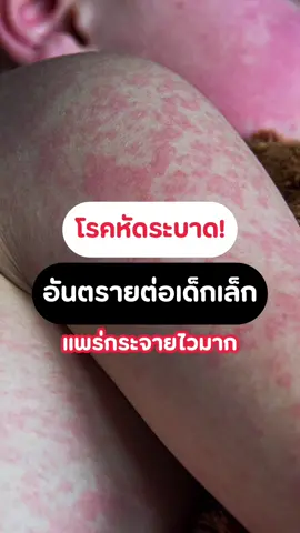 โรคหัดกำลังระบาด ‼️ เด็กเล็กเสี่ยงสูง ควรเฝ้าระวังอาการใกล้ชิดนะคะ #โรคหัด #เตือนภัยสุขภาพ #โรคระบาด #แม่และเด็ก 