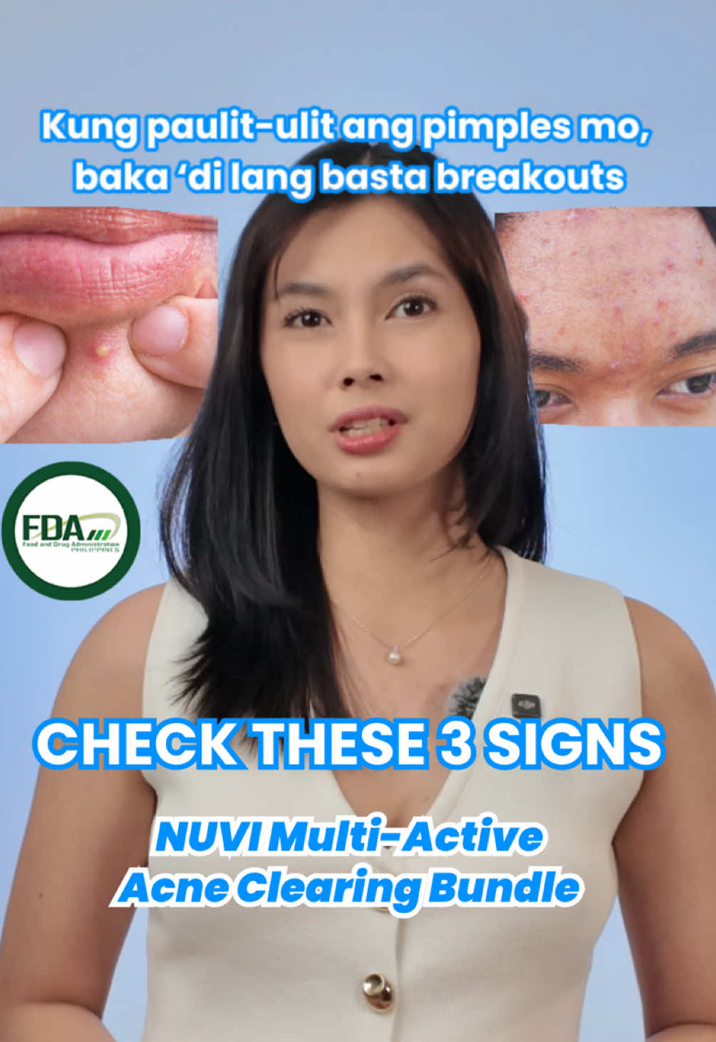 😰 Paulit-ulit na pimples? Oily skin at acne marks na hindi nawawala? Stop chasing quick fixes — go for a full, proven system with NUVI's Multi-Active Acne Clearing Bundle. 💧 ✅ FDA-approved, gentle, natural, and paraben-free.  Perfect for: • Hormonal pimples • Blackheads & whiteheads • Oily & sensitive skin 🛒 Tap the yellow basket & start your acne-free journey today! #NUVI #SkinCarePH #Acne #AcneTreatment #SensitiveSkin