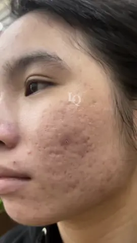 Cập Nhật Da Sẹo #chamsocdamun#chamsocdaseo#chamsocdanam#tanbinh#Lqspa&academy