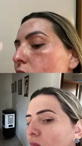 #creatorsearchinsights #melasma #tratamentomelasma #fy #clareadordemanchas 