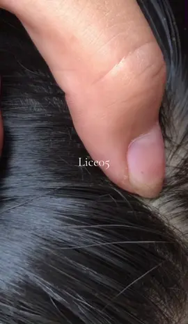 😱😱#omg #lice #liceremoval 