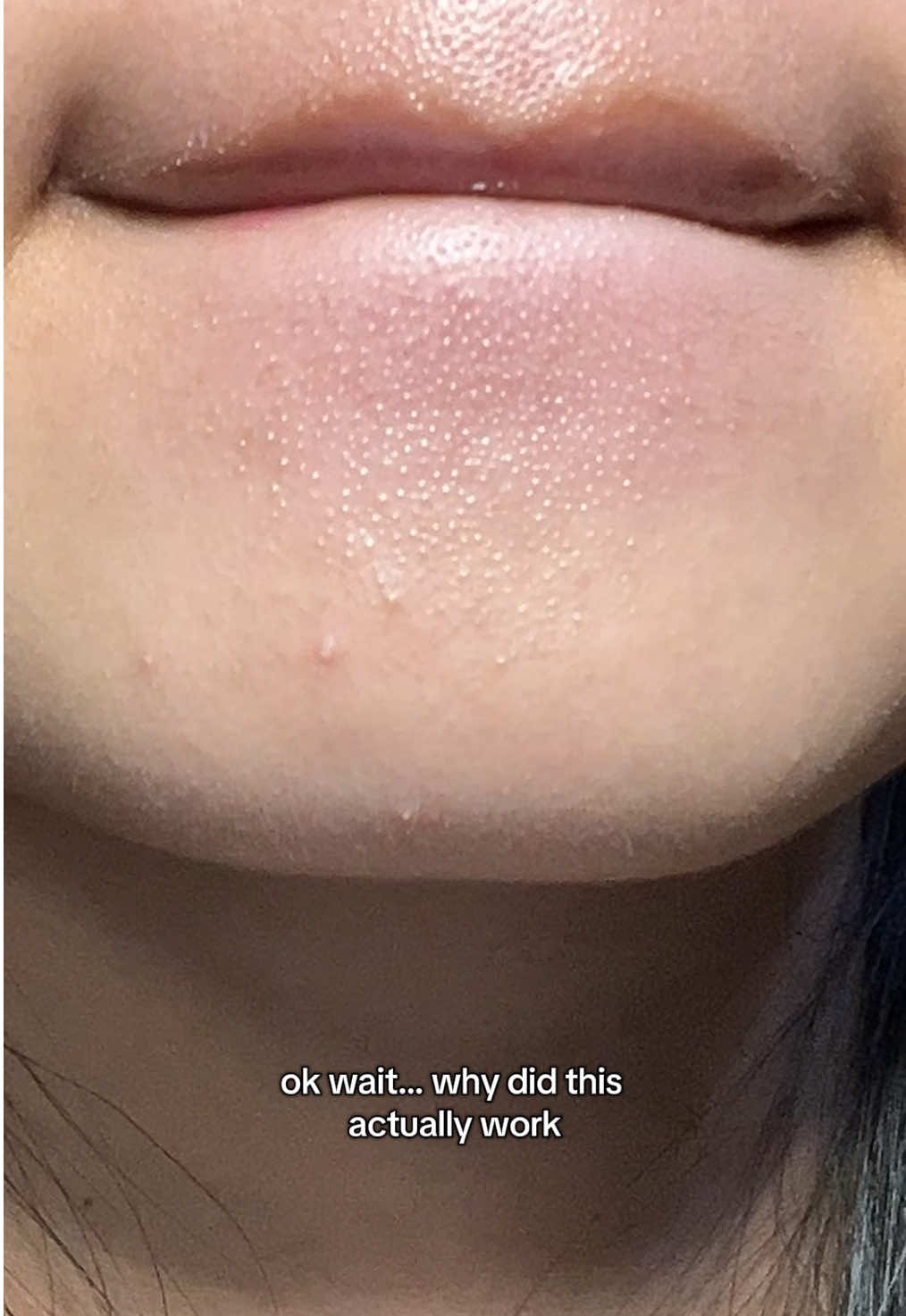 no regrets!! @Dr.Althea US #dralthea #345cream #acnetreatment #realpostacnecream #draltheashopee 