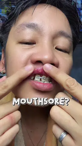 Say goodbye to singaw and irritation! YANDY Protective Wax Granules protect your cheeks and gums from poking wires and brackets. @YANDY.PH #bracescomfort #YANDY #oralcare #bracesjourney #bracesproblems 