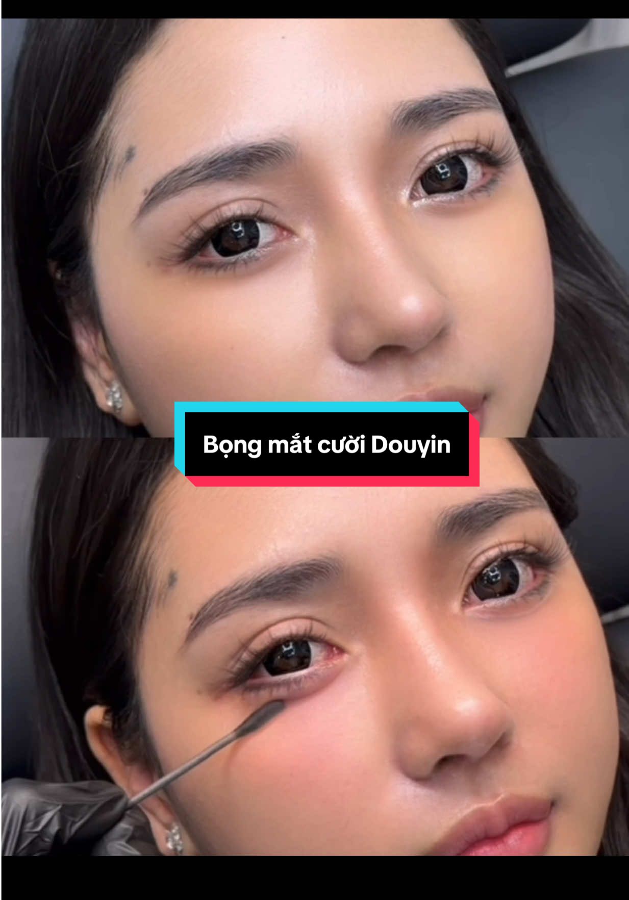 Gu mê Douyin thì không bỏ qua dịch vụ tiêm bọng mắt cười hack mắt to này nha chị em #xuhuongthammy #xuhuong 