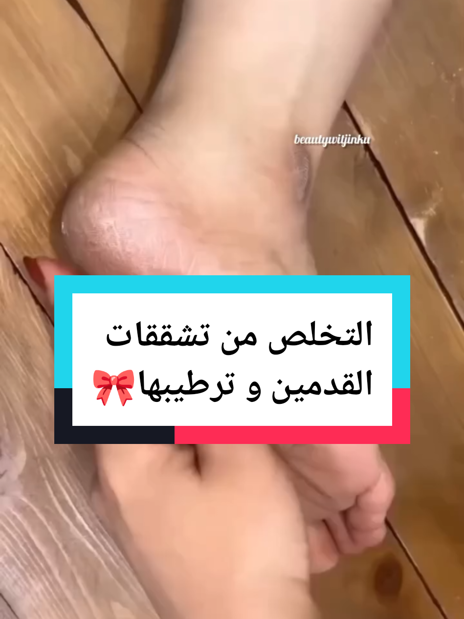 سر التخلص من تشققات القدمين نعومة من أول مرة 🌸✨  #تشققات_الأقدام #تشققات_الكعبين #ترطيب_القدمين #fyp #اكسبلور 