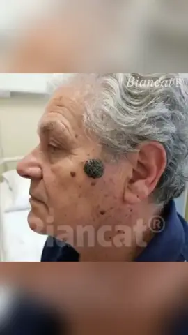 ✨ Tired of bumps, warts, or skin tags?