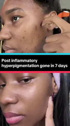 I was on a trip when my skin started acting up due to my period and fortunately I saw the mist at the mall so I grabbed it. Now I have the perfect combo to fight hyperpigmentation in just 7 days. #koreanskincare #darkspots #hyperpigmentation #acnescar #skincaretips 