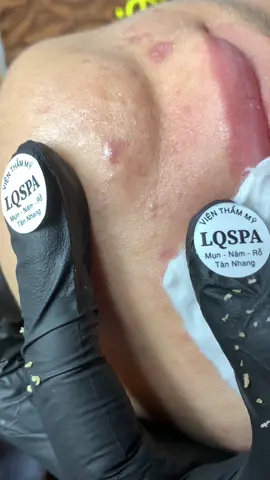 Mờ#chamsocdamun#chamsocdaseo#chamsocdanam#tanbinh#Lqspa&academy#