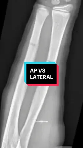 #CapCut #xray #radiology