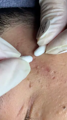 Sạch sẽ #chamsocdamun#chamsocdaseo#chamsocdanam#tanbinh#Lqspa&academy