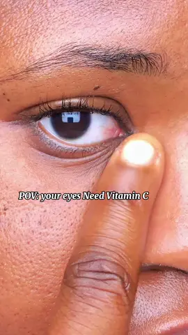 I have been using the Arencia Vitamin C Booster Shot for my dark circles and it’s been doing wonders in just 7 days 🥰 @Arencia  #Arencia #VitaminC #Acne #AcneScars #DarkSpots