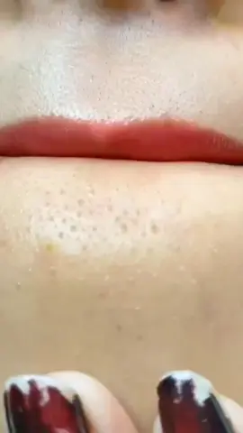 remova cravos e espinhas em apenas 3 minutos com essa simples receitinha caseira usando apenas esses ingredientes.😱😱 #cravos #cravoseespinhas #espinhas #dicasdepele 