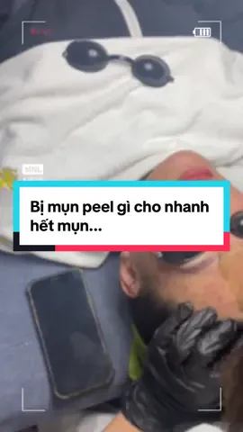Tết tới nơi rồi, peel mụn giúp da đẹp trước tết đi thôi#ngọc_thịnh_spa #dieutrimun #peelbongdatạinhà #spachuyendamun 