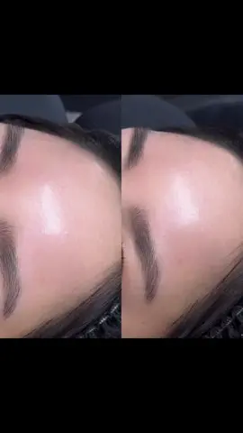 Tín đồ mê trán căng bóng tròn đều thì không bỏ qua dịch vụ làm đầy tráb và botox xoá nhăn nhe #xuhuongthammy #xuhuong ##trending 