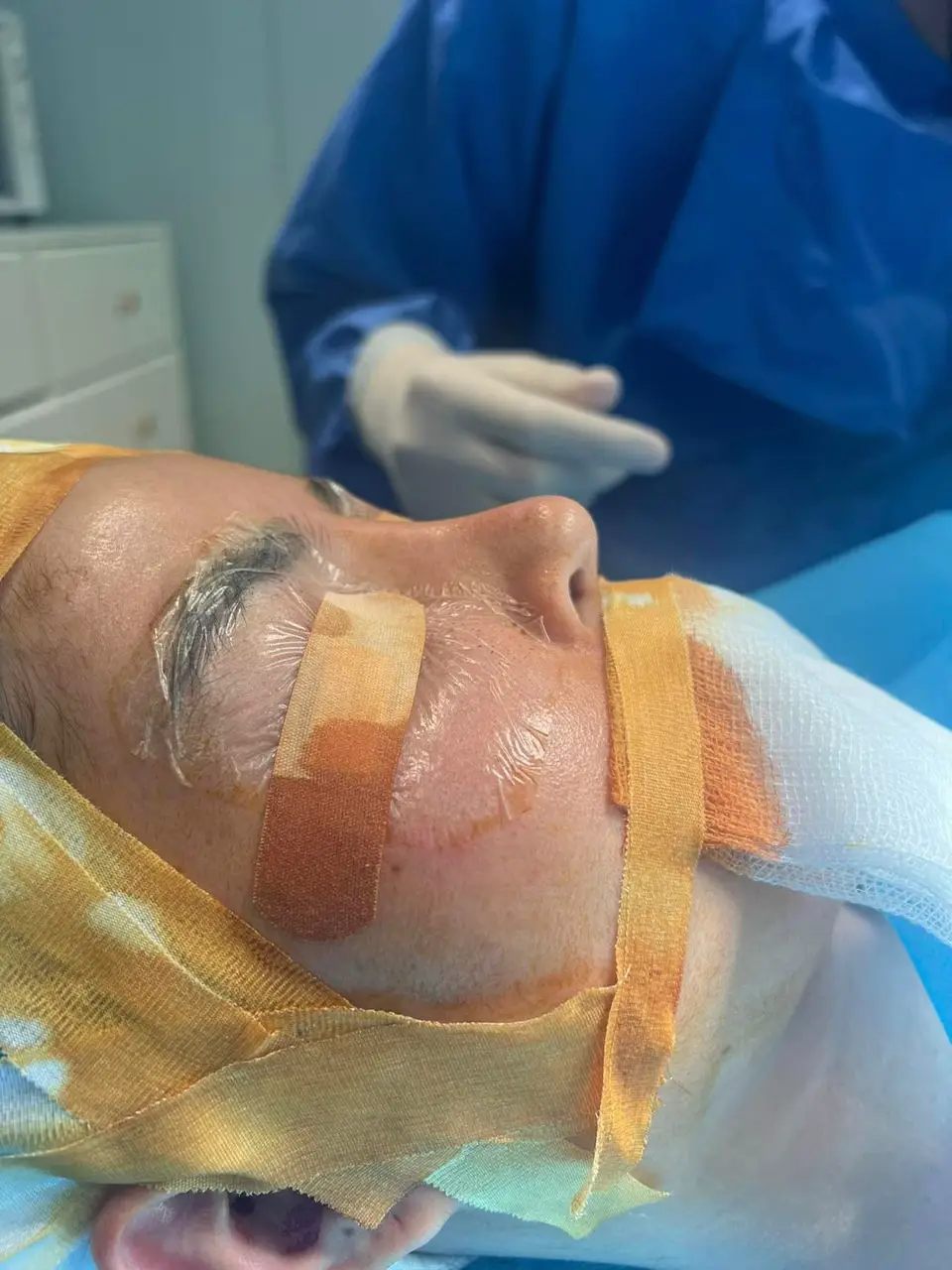 Done case mũi cao bay theo yêu cầu cho em gái❤️❤️#ChuyênNângMũiĐàNẵng #Combo_Nâng_Mũi_Cấu_Trúc #NângmũiCẤUTRÚC #KếtQuảThựcTế #nângmũicấutrúc 