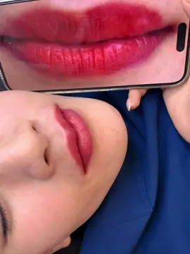 Cắt môi sẹo cho c gái Lạng Sơn #xh #bacninh #cắtmoidep #catmoi #sửamoiloi 