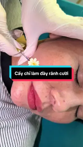 Cấy chỉ làm đầy rãnh cười#viraltiktok #xuhuongtiktok #tuongtac 
