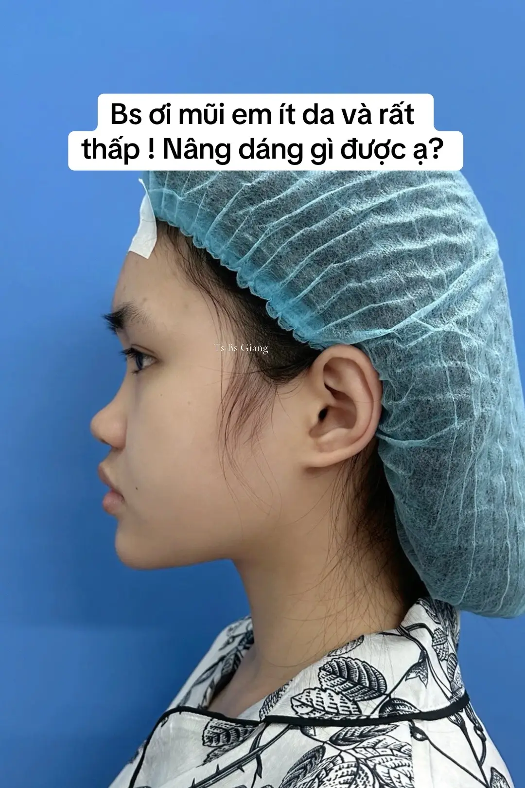 Mũi rất thấy và da mỏng ! Nên lựa chọn nâng dáng mũi gì ?? 