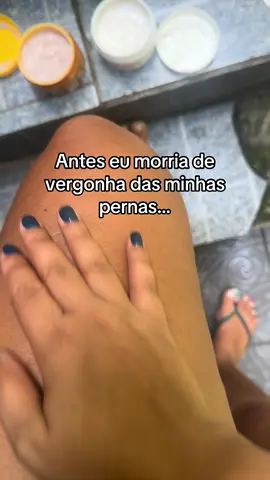 Minha autoestima tava lá em baixo. #lipedema#celulite#flacidez#estrias#