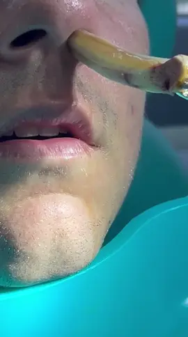 Muchas veces para mejorar la respiración se colocan tapones de merocel en las fosas nasales, con buena técnica su retiro no es doloroso    #foryour #draanasanchezotorrino #otorrinocaracas 