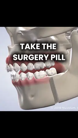 Surgery pill 💊 #fyp #surgery #bp #looksmax #ascension 