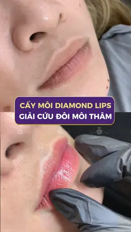 GIẢI CỨU MÔI THÂM: ƯU ĐÃI SỐC CHỈ CÒN 1/3 GIÁ. Nhậ lại 1 đôi môi hồng hào, đều màu. ĐĂNG KÝ NGAY - NHẬN ƯU ĐÃI#thammylinhanh #tmvlinhanh #phunmoi #caymoidiamondlips #phunmoitunhien 