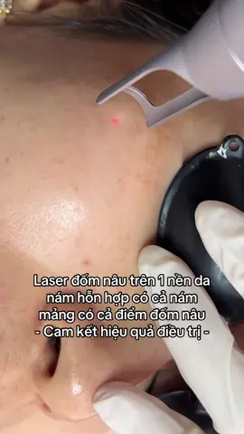 Laser đốm nâu trên 1 nền da nám hỗn hợp có cả nám mảng có cả điểm đốm nâu #lazer #viral #nám #trendingvideo #LearnOnTikTok 