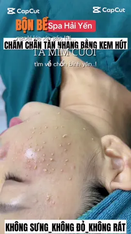 Kem hút nám đa năng #HAWAYVIETNAM #DOLAVIETNAM #spahaiyen #nám #Dieutrinamkhongxamlan 