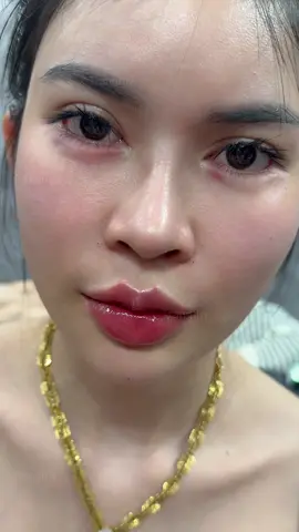 Đây là lí do mấy bà nên tiêm môi   #tiêmmôi #trangthyfiller #moibabylips 