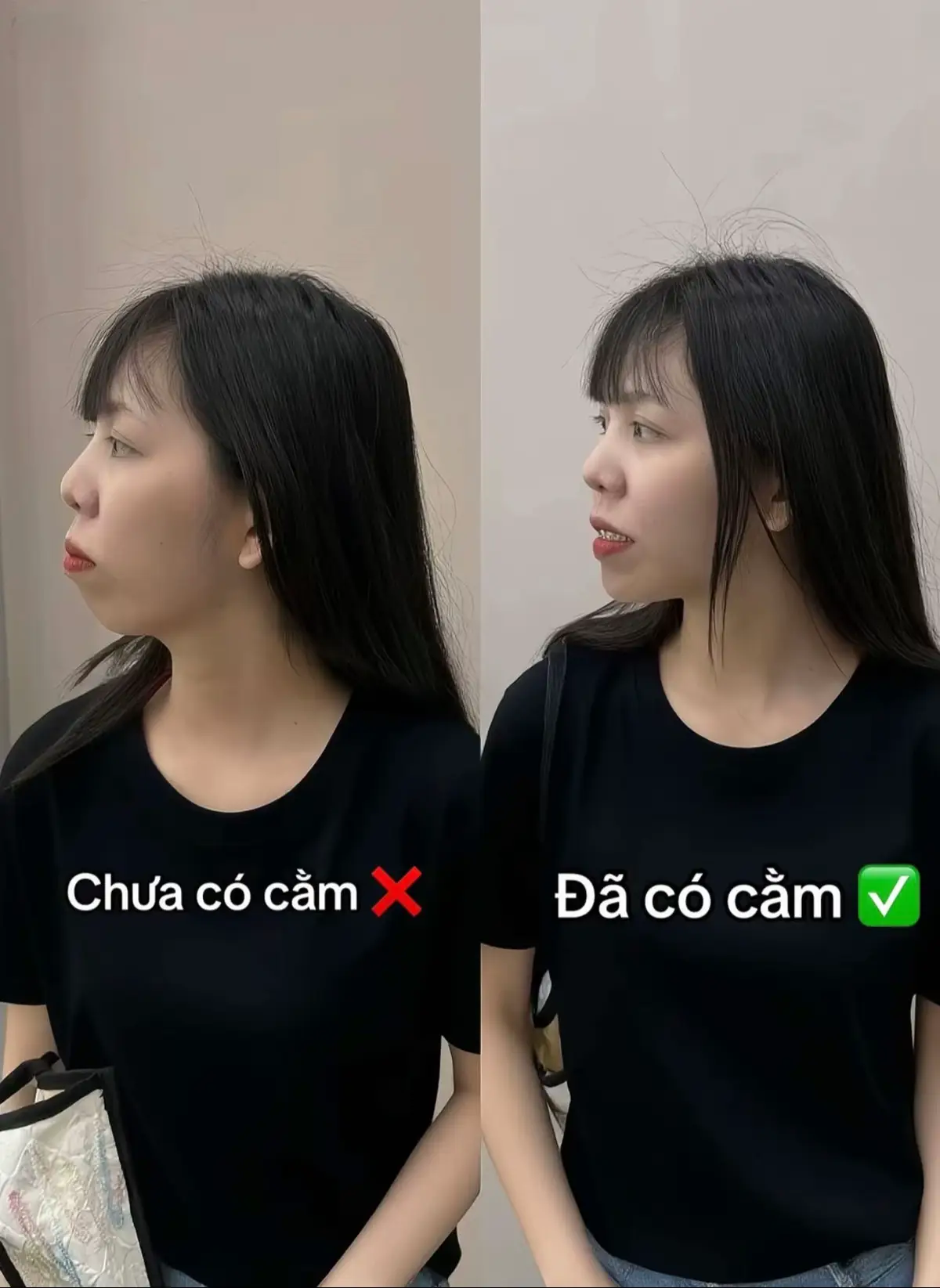 Nâng cấp chút xíu cho diện mạo thêm xinh. Tự tin từ mọi góc nhìn 💖 Nên tiêm cằm đi mấy bà ơi ➖ Chữa được hô ➖ Tình trạng cằm ngắn, lẹm ➖ Tự tin hơn… #lamdeptainha #tiemcam #xuhuongtiktok2025 