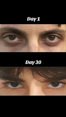 Fix eye areas ✨🦋  #foryoupage #foryouuu #eyes #pulling #growmyaccount✅ @Boombox Cartel 